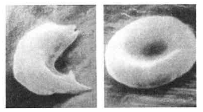 Photomicrographs of a defective and a normal red blood cell