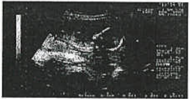 Ultrasound image of a foetus